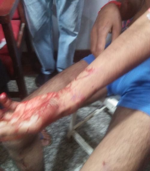 پی سی آر اور گوپال پورہ گرینیڈ دھماکوں میں پولیس اہلکار اور شہری زخمی