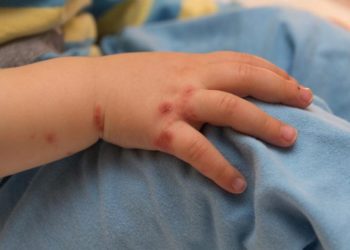 نجی اسکول کی متعدد طالبات میں ہاتھ‘ منہ اور پاؤں کی بیماری