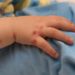 نجی اسکول کی متعدد طالبات میں ہاتھ‘ منہ اور پاؤں کی بیماری